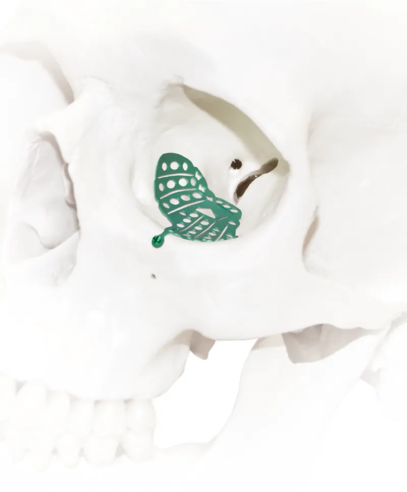 foto del mallas orbitarias marca zimmer biomet colocadas