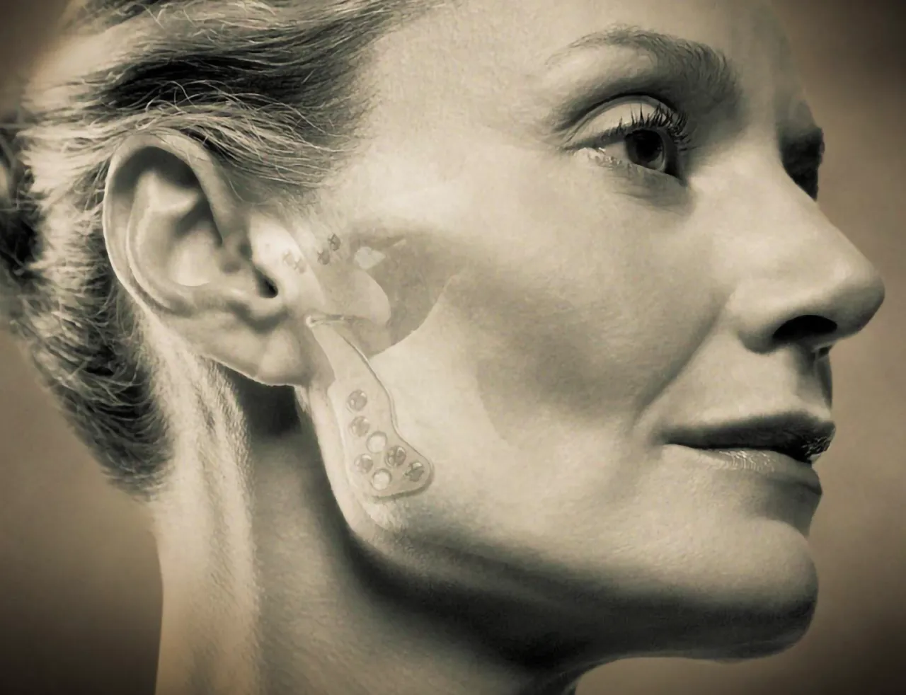 foto del sistema tmj marca zimmer biomet colocado