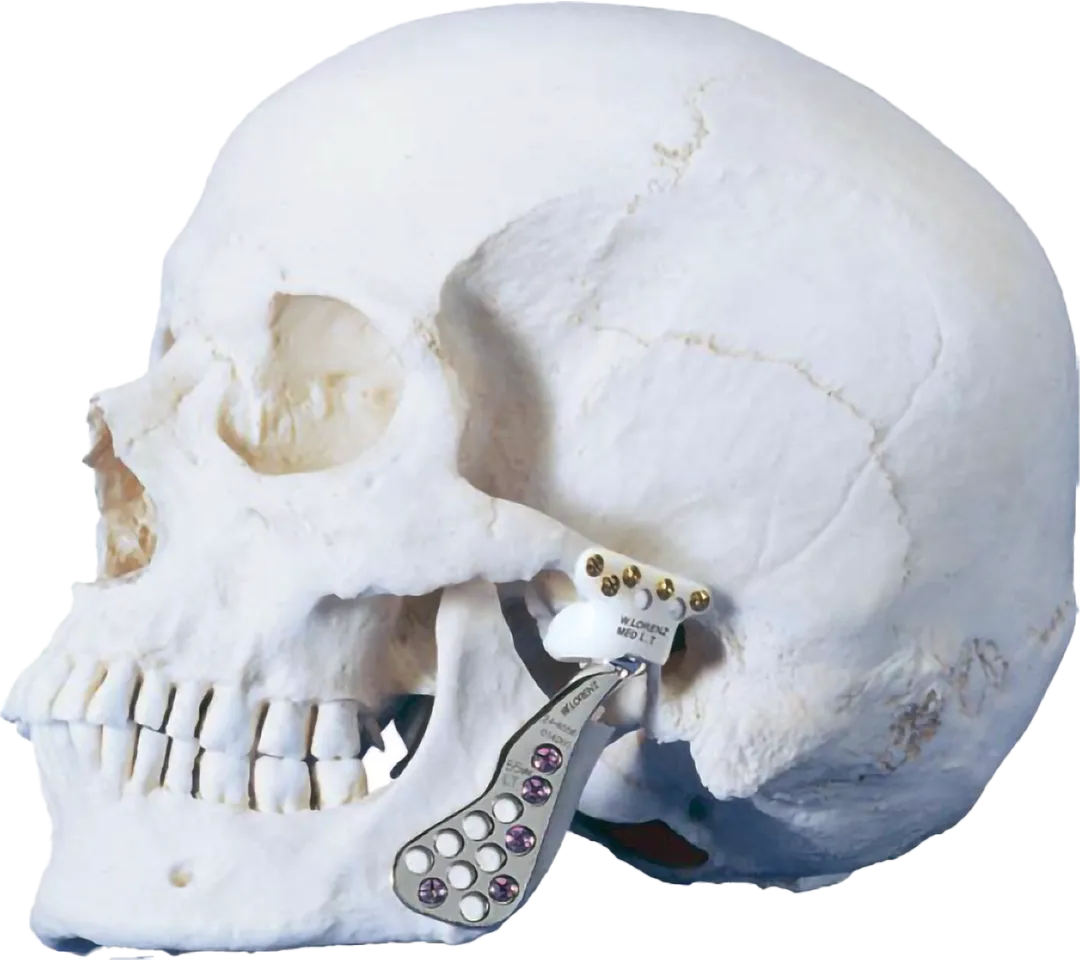 foto del sistema tmj marca zimmer biomet colocado