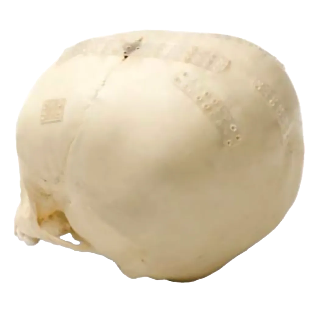 ilustracion de placas lactosorb marca zimmer biomet colocados