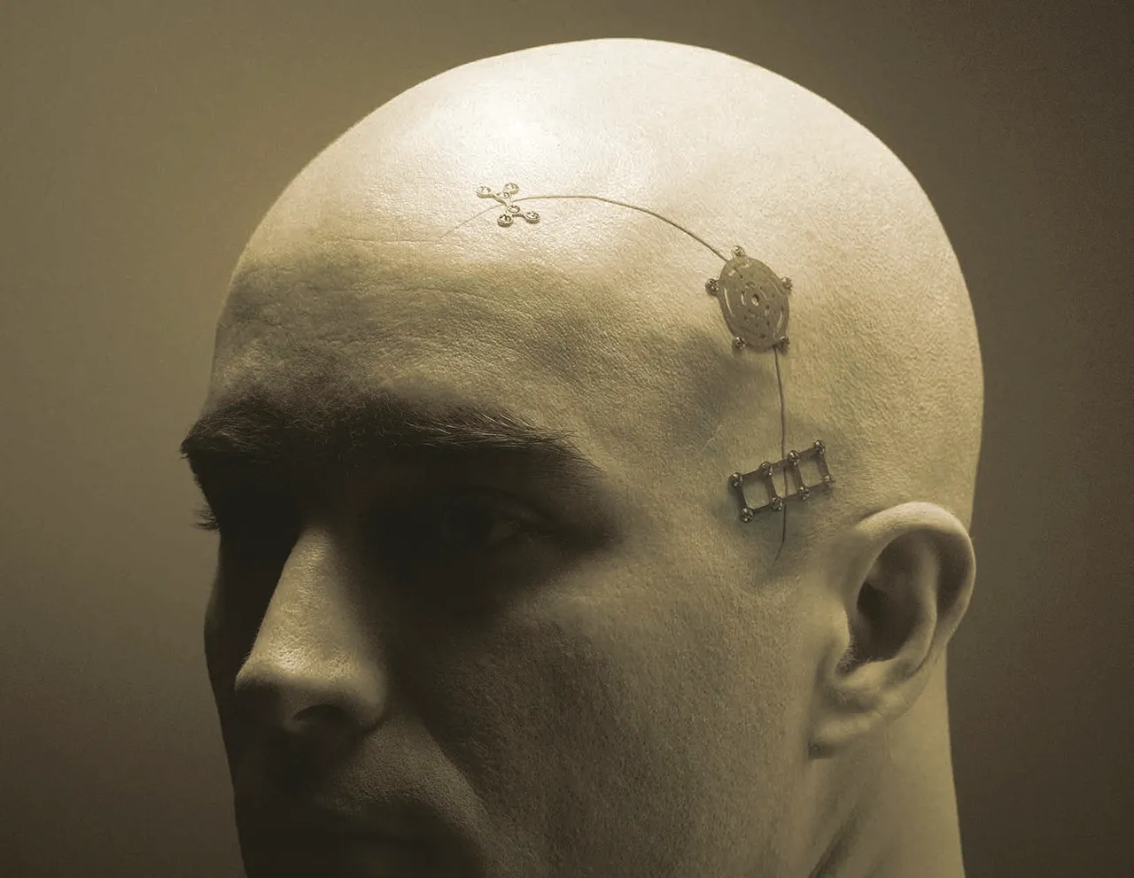 fotografia de implantes neuro plate marca zimmer biomet colocados