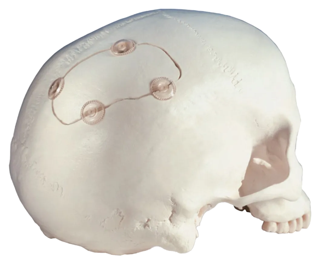 lustración de implantes rapidflap marca zimmer biomet colocados